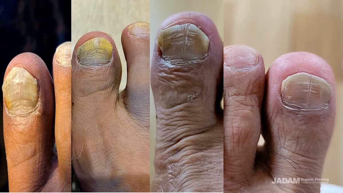 점차 발톱이 건강해지는 것이 눈으로 확인된다.